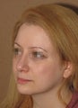 2 weeks after result of rhinoplasty/septoplasty