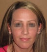 Septoplasty, nose job rhinoplasty