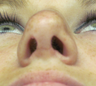 Septoplasty