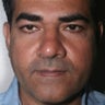 Reconstructive Septorhinoplasty