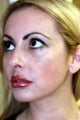 Rhinoplasty and Septoplasty
