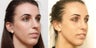 Septoplasty with rhinoplasty