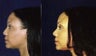 Rhinoplasty and Septoplasty