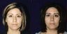 Rhinoplasty and Septoplasty