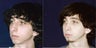Rhinoplasty and Septoplasty