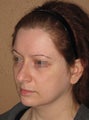 2 weeks after result of rhinoplasty/septoplasty