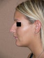 Nose job - rhinoplasty