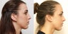 Septoplasty with rhinoplasty