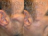 Facial Wasting Treatment for volume loss resulting from HIV antiviral therapy