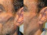 Facial Wasting Treatment for volume loss resulting from HIV antiviral therapy