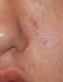 Lesion Removal, Excision