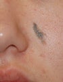 Lesion Removal, Excision
