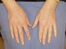 Hand Rejuvenation with Radiesse