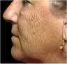 CO2 Laser Skin Resurfacing