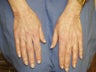 Hand Rejuvenation with Radiesse