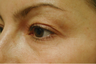 Laser eyelift