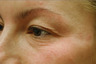 Laser eyelift