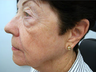 Fractional laser therapy