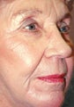 Laser Resurfacing