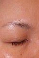 Skin Tag Removal Before Photo 