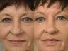 Deep Peel