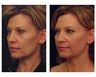 YAG Laser Skin Tightening