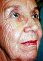 Laser Resurfacing