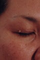 Skin Tag Removal Before Photo 