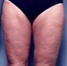 Slim Lipo