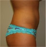 Smart Lipo