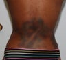 Smart Lipo