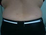 Smartlipo / liposuction