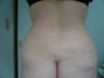 Smartlipo / liposuction