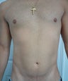 Smartlipo / liposuction