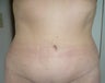 Smartlipo / liposuction