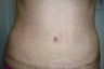 Smartlipo / liposuction