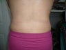Smartlipo / liposuction