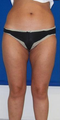 Laser Liposuction