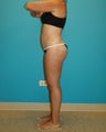 Smartlipo liposculpture of abdomen