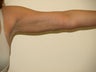 SMARTLIPO