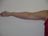 Smart Lipo