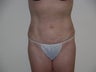 Smartlipo