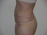 Smart Lipo