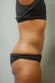 SmartLipo Abs & Love Handles 