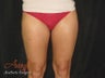 Smart Lipo - Outer Thighs