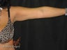 Smart Lipo - Arms