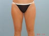 Inner Thigh Smart Liposuction