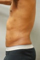SmartLipo™  Restoration of a Male's Abs 