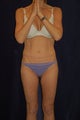 smart lipo  