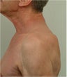 Buffalo Hump Reduction